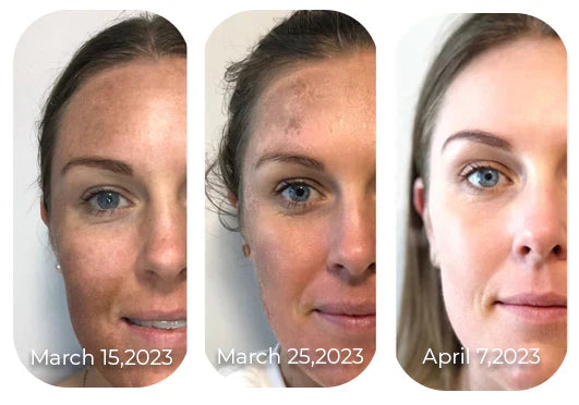 Suero Facial Corrector de Melanina