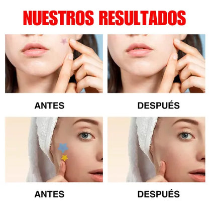Parches para acné | Despídete del Acné de Forma Rápida y Efectiva
