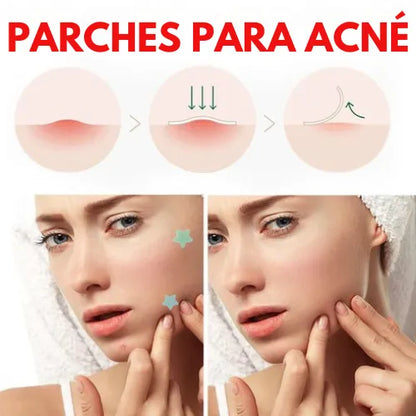 Parches para acné | Despídete del Acné de Forma Rápida y Efectiva